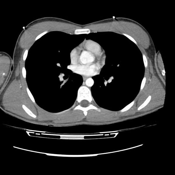 File:Normal dual-phase trauma CT chest,abdomen and pelvis (Radiopaedia 48092-52899 A 29).jpg