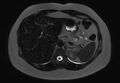 Normal liver MRI with Gadolinium (Radiopaedia 58913-66163 E 22).jpg
