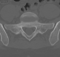 Normal lumbar spine CT (Radiopaedia 46533-50986 Axial bone window 66).png
