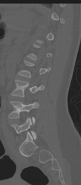 File:Normal lumbosacral CT (Radiopaedia 37923-39867 Sagittal bone window 35).png