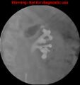 Normal retrograde pyelography of a native and transplant kidney (Radiopaedia 40480-43054 Native kidney 5).jpg