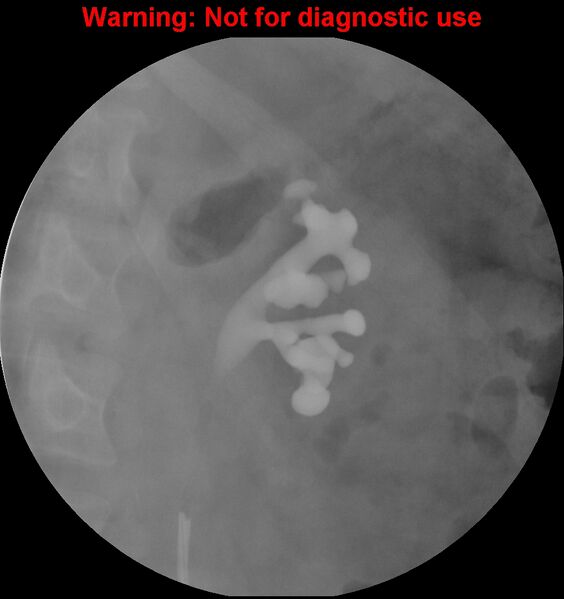 File:Normal retrograde pyelography of a native and transplant kidney (Radiopaedia 40480-43054 Native kidney 5).jpg