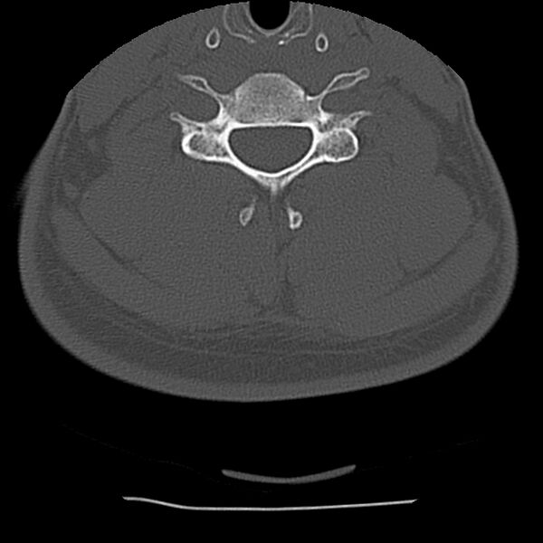 File:Normal trauma spine imaging (Radiopaedia 31753-32686 Axial bone window 55).jpg