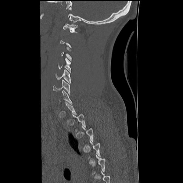 File:Normal trauma spine imaging (Radiopaedia 31753-32686 Sagittal bone window 32).jpg