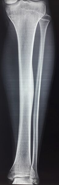 File:Osteoid osteoma - tibia (Radiopaedia 83572-98682 Frontal 1).jpg