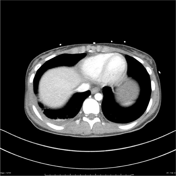 File:Traumatic renal artery dissection and pancreatic transection (Radiopaedia 37061-38739 Axial 289).jpg