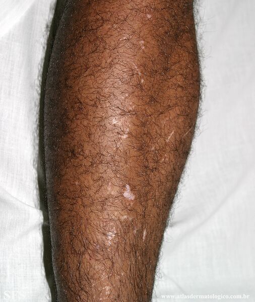 File:Vitiligo (Dermatology Atlas 56).jpg