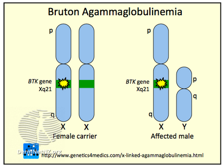 X-linked agammaglobulinemia