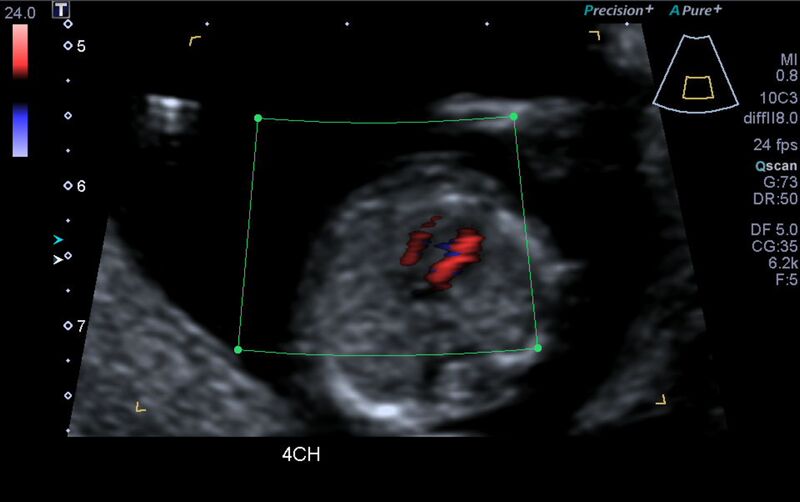 File:1st trimester nuchal-morphology ultrasound (Radiopaedia 44706-48477 Heart views cine with colour 73).jpg
