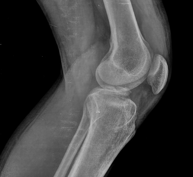 File:ACL avulsion fracture (Radiopaedia 76983).PNG