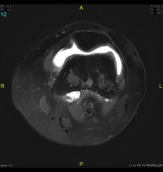 File:ACL mucoid degeration with cystic changes (Radiopaedia 48428-53341 Axial PD fat sat 9).jpg