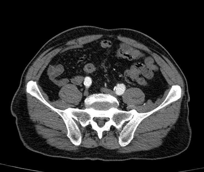 File:Abdominal aortic aneurysm (Radiopaedia 22421-22458 C+ arterial phase 70).jpg