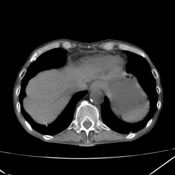 File:Abdominal aortic aneurysm (Radiopaedia 23703-23856 Axial non-contrast 6).jpg