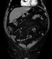 Abdominal aortic aneurysm (Radiopaedia 25855-26001 Coronal C+ arterial phase 3).jpg