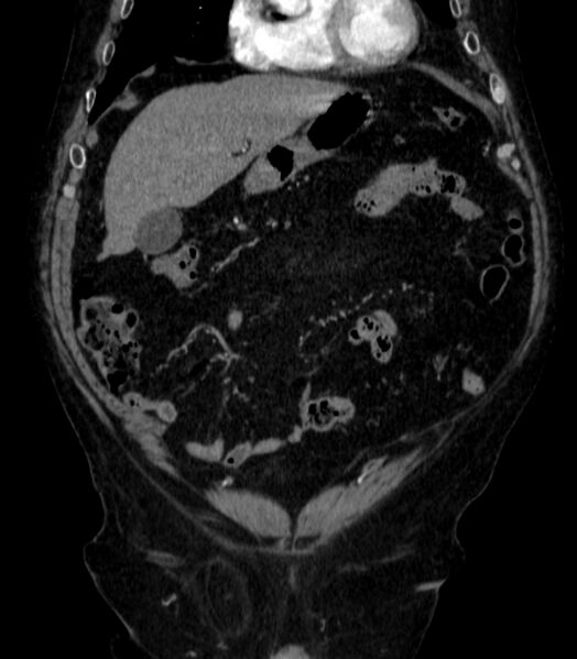 File:Abdominal aortic aneurysm (Radiopaedia 25855-26001 Coronal C+ arterial phase 3).jpg