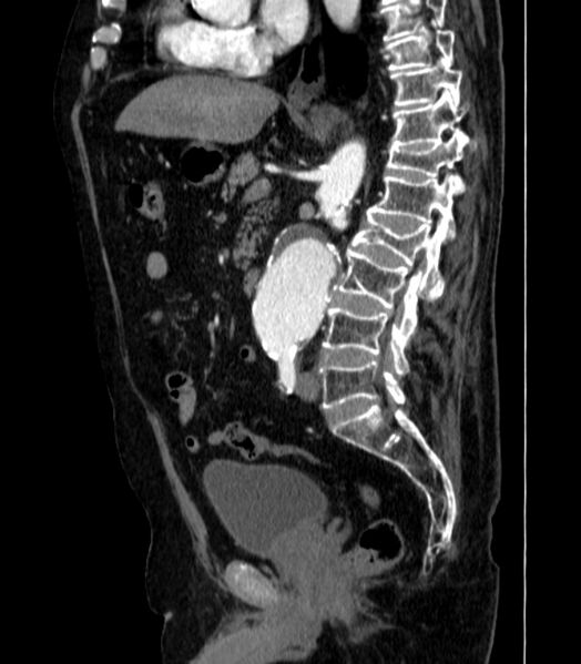 File:Abdominal aortic aneurysm (Radiopaedia 25855-26001 Sagittal C+ arterial phase 28).jpg