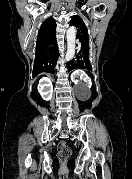 File:Abdominal aortic aneurysm (Radiopaedia 85063-100606 Coronal C+ arterial phase 43).jpg