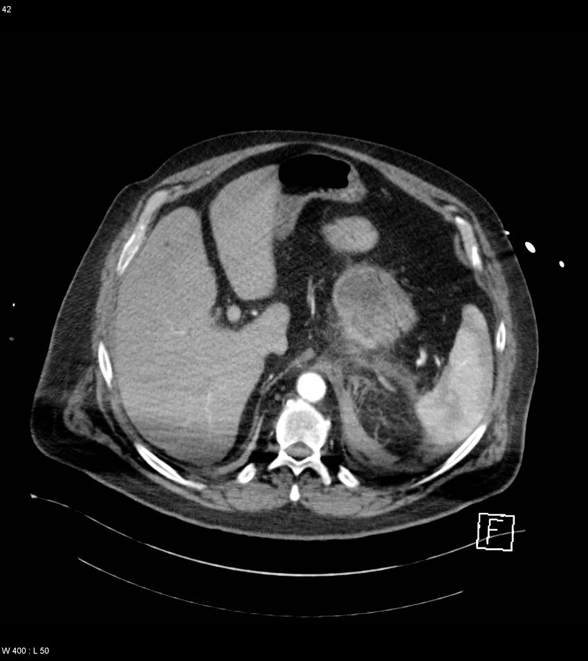 Abdominal aortic aneurysm with intramural hematoma then rupture (Radiopaedia 50278-55632 Axial C+ arterial phase 41).jpg