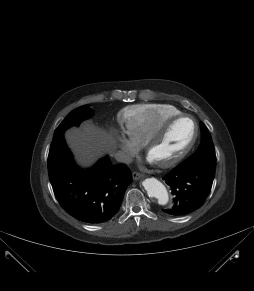 File:Abdominal aortic aneurysm with thrombus fissuration (Radiopaedia 46218-50618 Axial C+ arterial phase 2).jpg