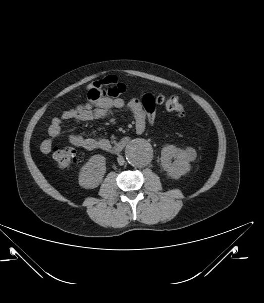 File:Abdominal aortic aneurysm with thrombus fissuration (Radiopaedia 46218-50618 Axial non-contrast 27).jpg