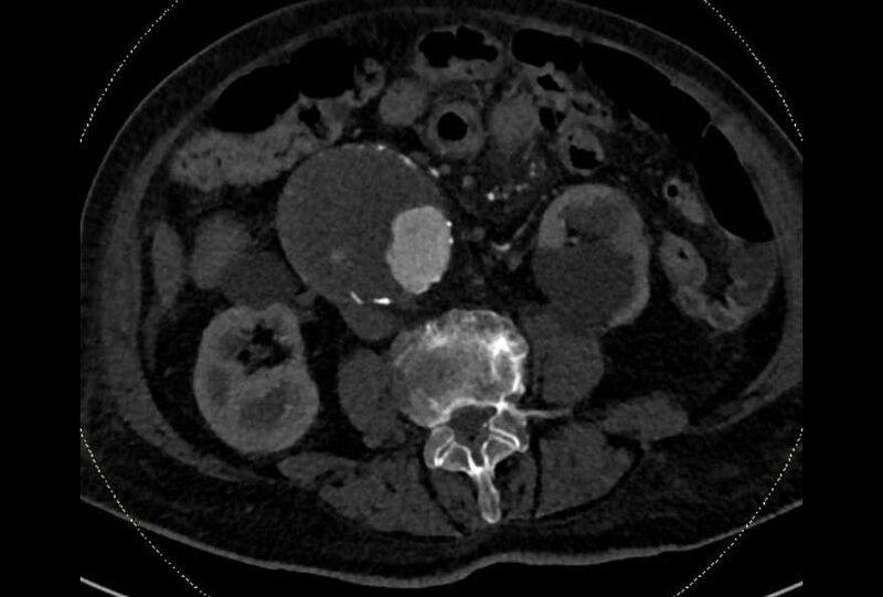 File:Abdominal aortic aneurysm with thrombus fissuration (Radiopaedia 73192-83919 Axial C+ arterial phase 109).jpg