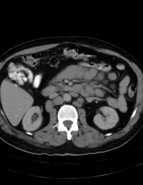 File:Abdominal lymphoma - with sandwich sign (Radiopaedia 53486-59492 Axial C+ portal venous phase 22).jpg