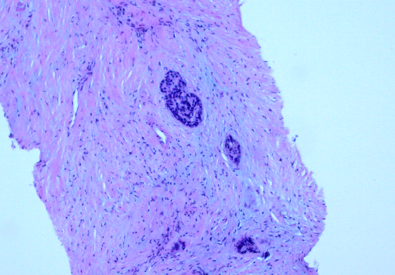 File:Abdominal wall metastasis from colorectal carcinoma (Radiopaedia 31016-31722 H&E 1).png