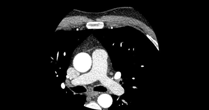File:Aberrant left main coronary artery (ALMCA) arising from the right sinus with interarterial course (Radiopaedia 63251-71814 Axial C+ arterial phase 21).JPG