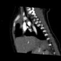 Aberrant left pulmonary artery (pulmonary sling) (Radiopaedia 42323-45435 Sagittal C+ arterial phase 33).jpg