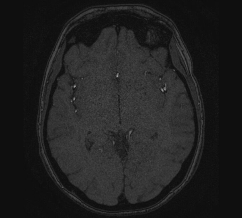 Accessory middle cerebral artery and ICA aneurysm (Radiopaedia 22656-22674 MRA 69).jpg