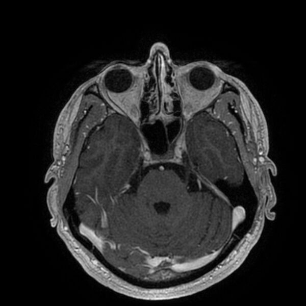 File:Acoustic schwannoma - intracanalicular (Radiopaedia 37247-39024 Axial T1 C+ 81).jpg