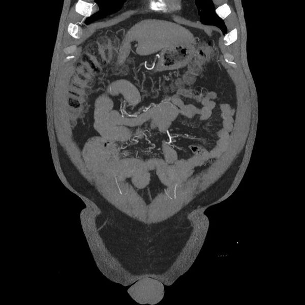 File:Active colonic bleed on CT (Radiopaedia 49765-55025 Coronal art MIP 17).jpg