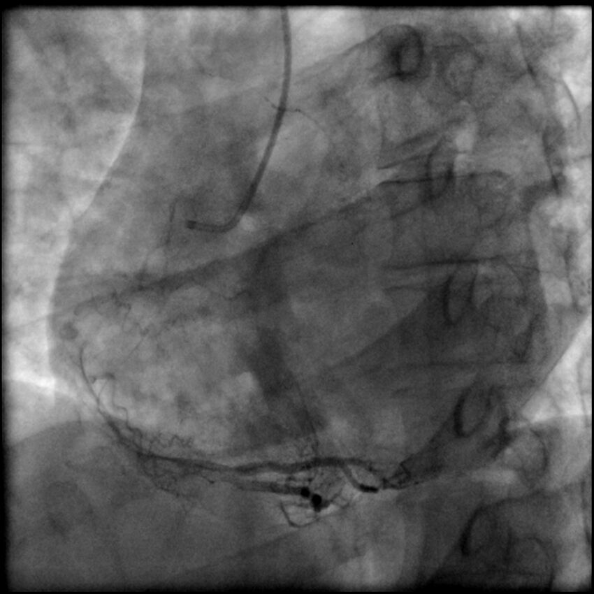 Acute anteroseptal myocardial infarction (Radiopaedia 68409-77946 RAO straight RCA 62).jpg