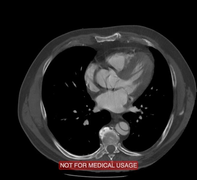 File:Acute aortic dissection - Stanford type A (Radiopaedia 40661-43285 Axial C+ arterial phase 40).jpg