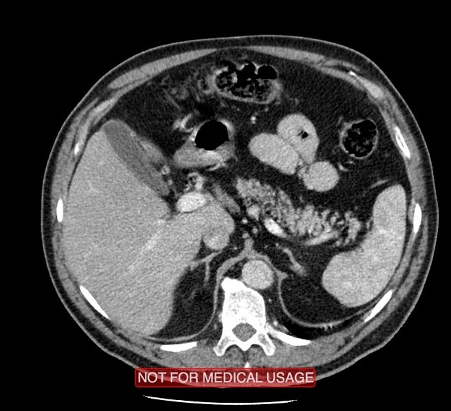 File:Acute aortic dissection - Stanford type A (Radiopaedia 40661-43285 Axial C+ portal venous phase 75).jpg