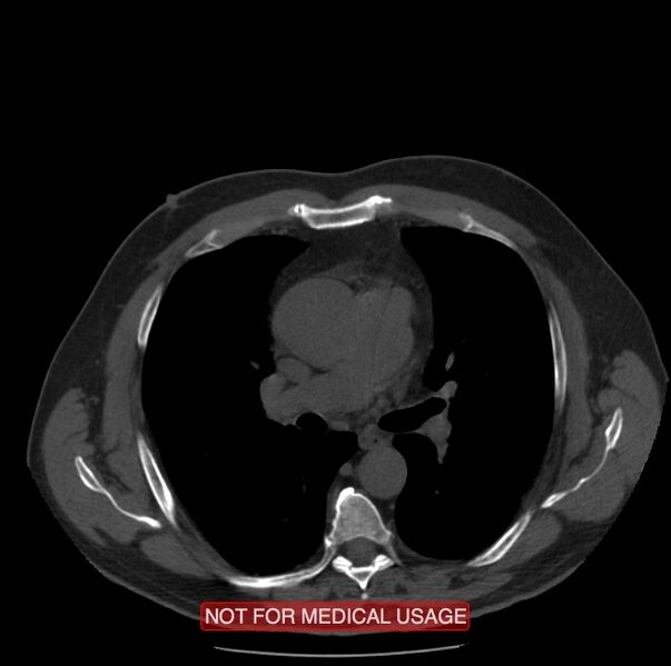 File:Acute aortic dissection - Stanford type A (Radiopaedia 40661-43285 Axial non-contrast 23).jpg
