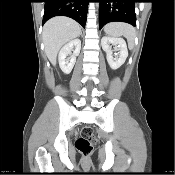 File:Acute appendicitis (Radiopaedia 25364-25615 C+ portal venous phase 22).jpg