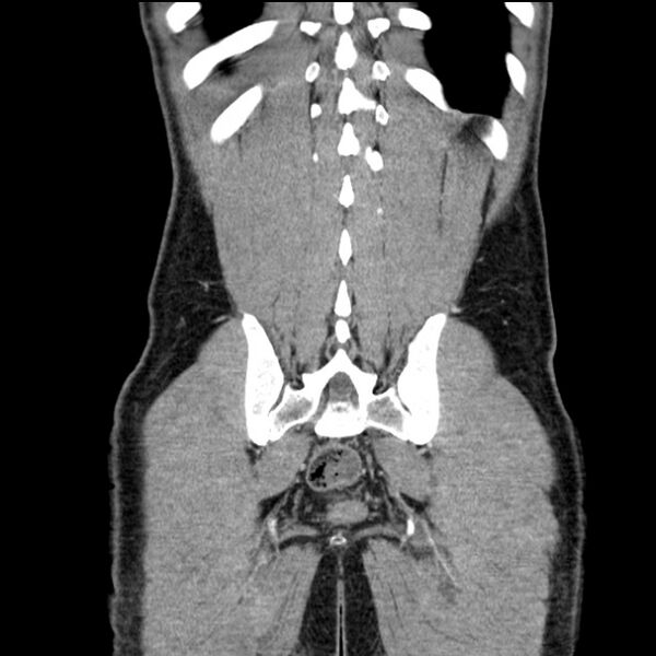 File:Acute appendicitis (Radiopaedia 27049-27227 Coronal C+ portal venous phase 49).jpg