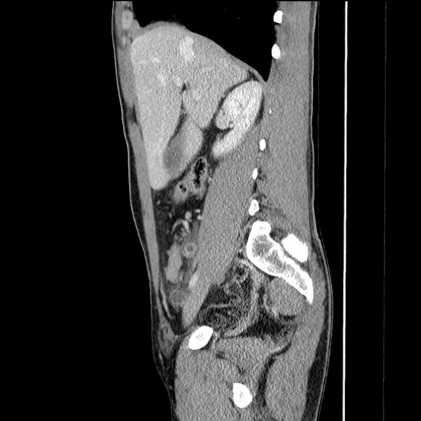 File:Acute appendicitis (Radiopaedia 27049-27227 Sagittal C+ portal venous phase 28).jpg