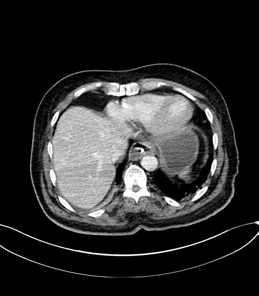 Acute arterial mesenteric ischemia (Radiopaedia 78238-90828 Axial C+ portal venous phase 21).jpg
