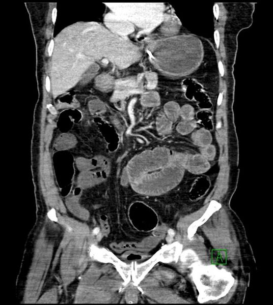 File:Acute arterial mesenteric ischemia (Radiopaedia 78238-90828 Coronal C+ portal venous phase 44).jpg
