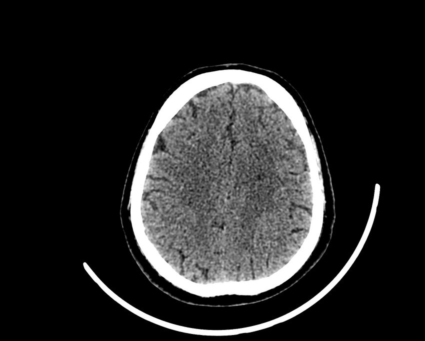 Acute cerebral infarct (Radiopaedia 35604-37123 Axial non-contrast 75).jpg