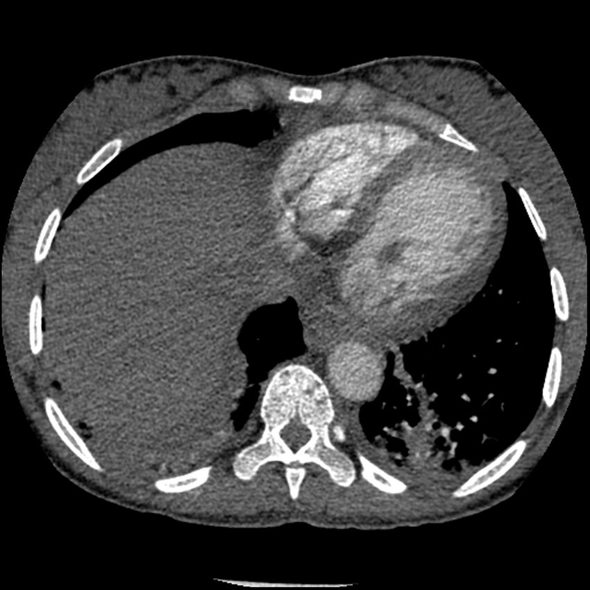 Acute chest syndrome - sickle cell disease (Radiopaedia 42375-45499 Axial C+ CTPA 147).jpg