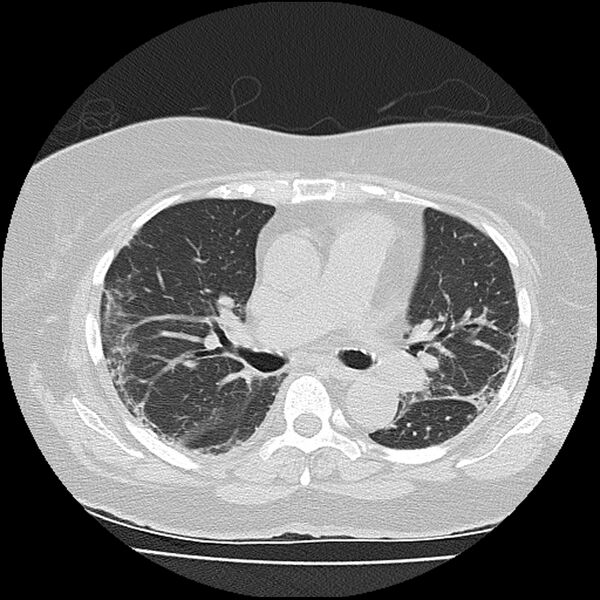 File:Acute interstitial pneumonitis (Radiopaedia 45404-49452 Axial lung window 43).jpg
