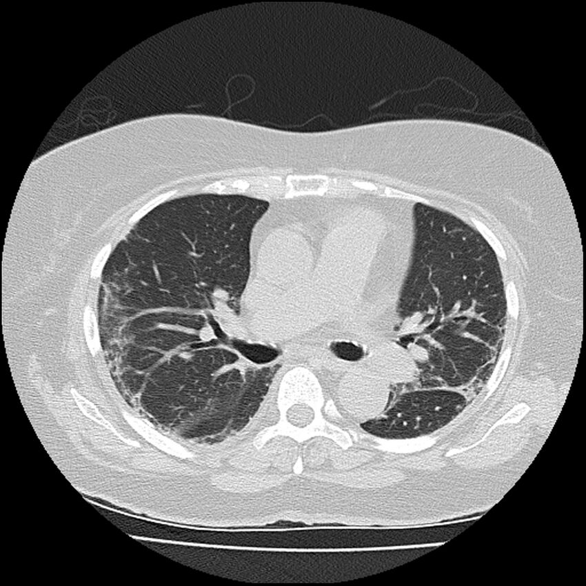 Acute interstitial pneumonitis (Radiopaedia 45404-49452 Axial lung window 43).jpg