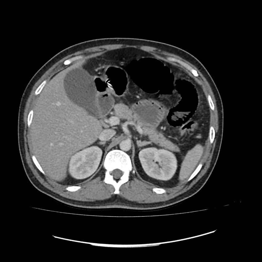 Acute mesenteric ischemia - superior mesenteric artery thrombosis (Radiopaedia 73947-84776 Axial C+ portal venous phase 22).jpg