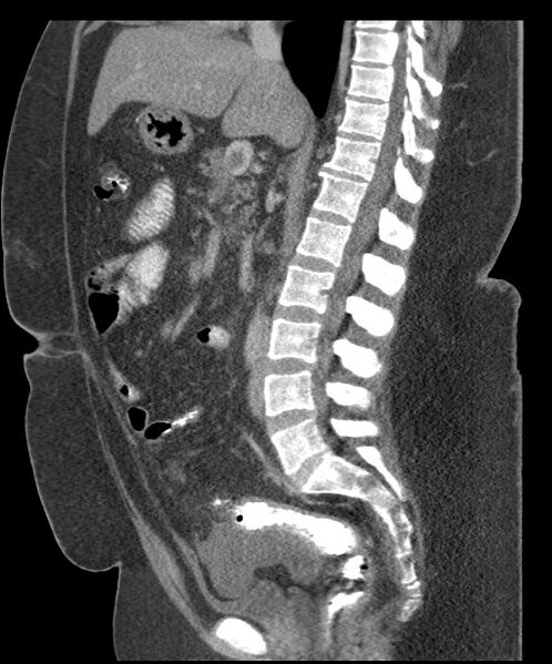 File:Acute mesenteric venous ischemia (Radiopaedia 46041-50383 Sagittal C+ portal venous phase 58).jpg