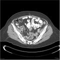 Acute pancreatitis (Radiopaedia 19136-19117 Axial C+ portal venous phase 35).jpg