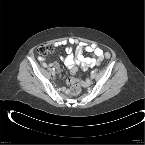 File:Acute pancreatitis (Radiopaedia 19136-19117 Axial C+ portal venous phase 35).jpg
