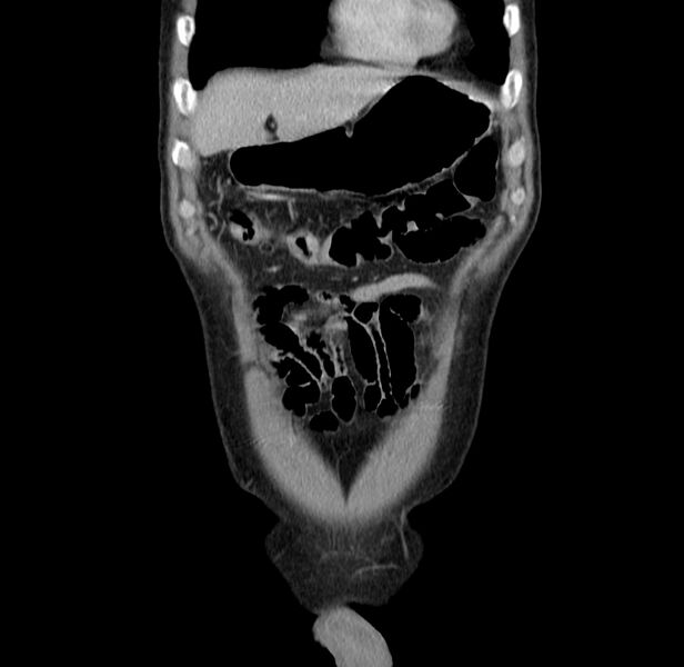 File:Acute pancreatitis (Radiopaedia 22572-22596 Coronal C+ portal venous phase 11).jpg